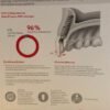 Angulated Screw Channel Solutions Study Snapshot DE